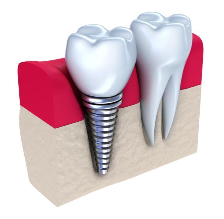 Dental Implant anatomy in Topeka, KS