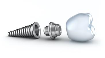 dental implant illustration