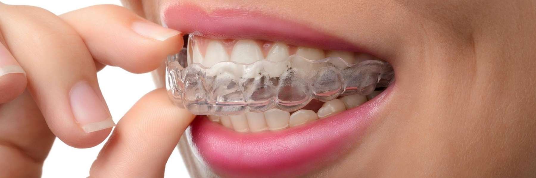Spark Clear Aligners in Topeka, KS