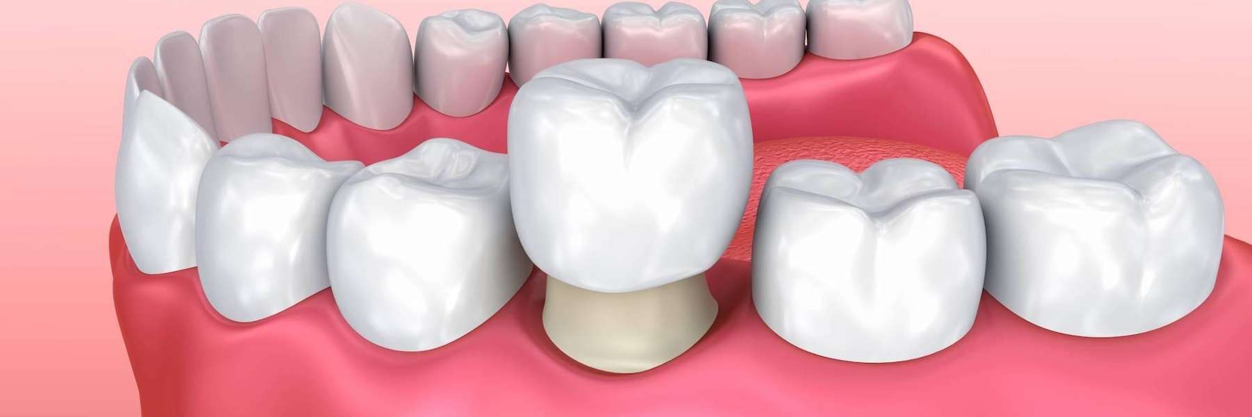 dental crown illustration in topeka ks