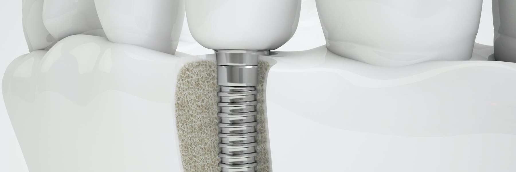 dental implant post