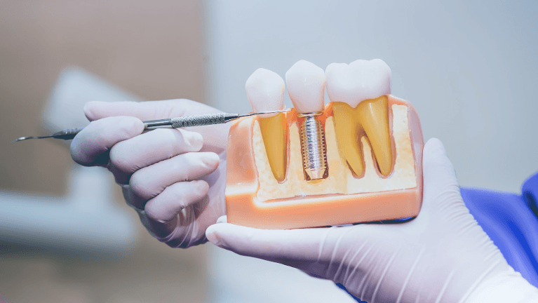 dental implant illustration
