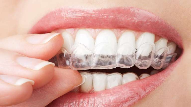 Spark Clear Aligners in the mouth
