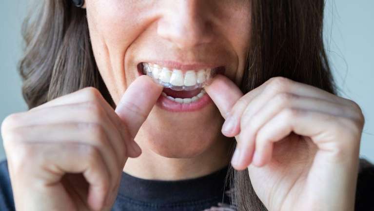 Spark Clear Aligners