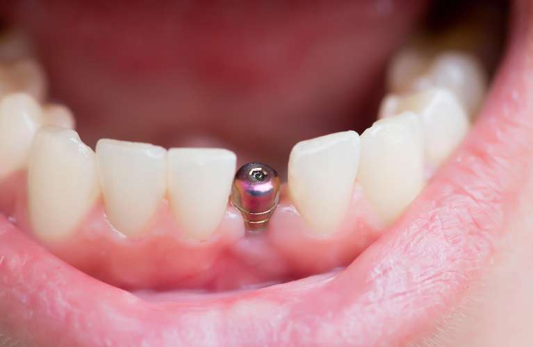 dental implant screw