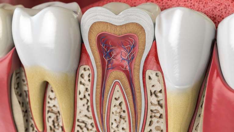 root canal picture