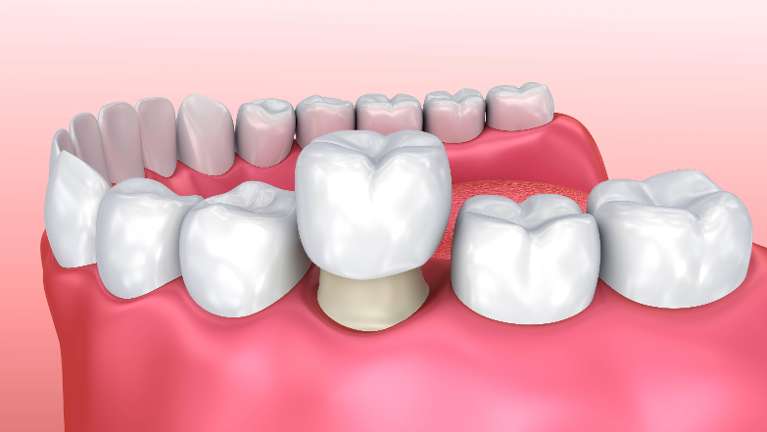 dental crown image